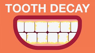 What causes tooth decay [upl. by Zoila]