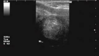 PERINEAL ULTRASOUND [upl. by Nidya]