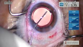 PanOptix Trifocal IOL [upl. by Layod]