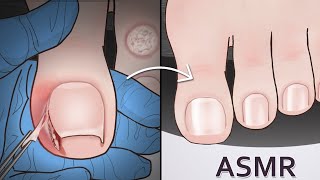 ASMR｜Ingrown Toenail and Corn removal treatment animation [upl. by Navoj537]