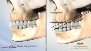 Malocclusion  Overjet Overbite Secondary to Vertical Maxillary Excess [upl. by Ahsinan251]