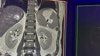 Coledocolitiasis conducto hepatico derecho aberrante y cistico con inserción baja [upl. by Lanza]