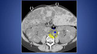 Bilateral Renal Cysts [upl. by Nnawtna]