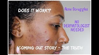 Acne Diaries  With Pics  1 Month Doxycycline  RetinA Tretinoin NO DERMATOLOGIST NEEDED [upl. by Naelcm]