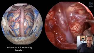 Chordomas and Chondrosarcomas Surgical Anatomy and Technical Nuances [upl. by Prosper]