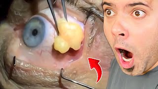 Popping huge blackheads and Giant Pimples Best Pimple Popping Videos [upl. by Nivonod]