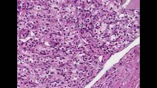 Histopathology KidneyRenal cell carcinoma [upl. by Atterrol]