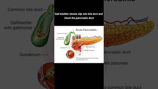 Acute pancreatitis shorts healthmedia [upl. by Akehsay703]