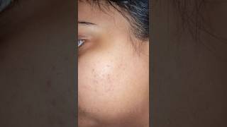 adapalene gelhow I used to cure my acne [upl. by Nhguavahs]