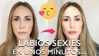 👄 Armonización de LABIOS con ácido hialurónico 1ml 💉💋 [upl. by Avin785]