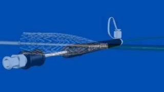 Zilver Vascular Stent [upl. by Venu730]