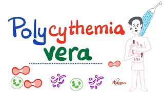 Polycythemia Vera PV  Myeloproliferative Neoplasm MPN  Erythrocytosis  Hematology [upl. by Jock]