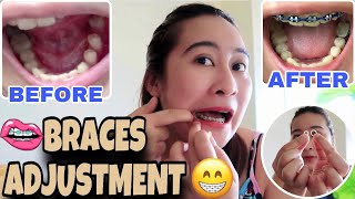 WEARING ELASTICS RUBBER SIZE 25 BRACES ADJUSTMENT [upl. by Sioux]