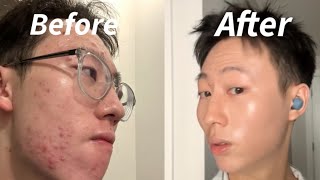 How I CURED My Acne  Accutane Transformation [upl. by Ready]