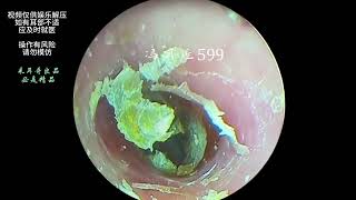 Hard cerumen removal dry pieces on the ear canal and eardrum [upl. by Ramunni257]