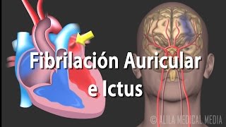 Fibrilación Auricular e Ictus Animación Alila Medical Media Español [upl. by Sredna272]