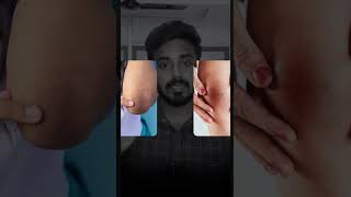 Dark Knees amp Elbows treatment  Dermatologist  Dr Thamizhinian [upl. by Ivy]