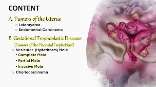 Female genital tumors II Uterus and Trophoblast شرح محاضرة [upl. by Htidirem897]