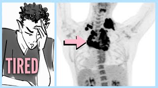 LYMPHOMA After Ignoring 6 WARNING Signs [upl. by Nillad]