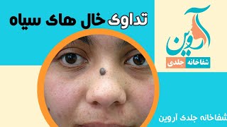 Mole removal with laser برداشتن خال سیاه با لیزر [upl. by Viccora]