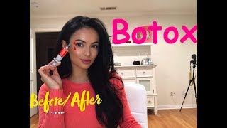 Botox Before and After Eyebrow Lift [upl. by Demetre]