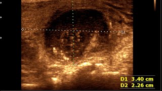 Thyroid colloid cyst  Thyroid cyst  Colloid goiter [upl. by Aihsemaj]