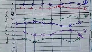 Audiogram  Assessment of Type of Hearing Loss  Part 2 [upl. by Nerita838]