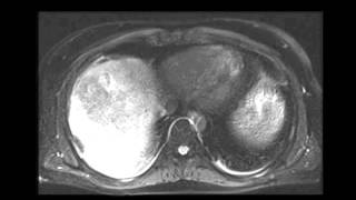 Large hepatocellular carcinoma HCC [upl. by Inavoj]