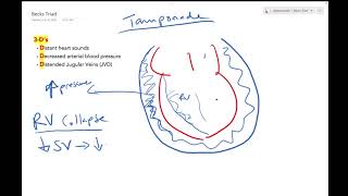 Cardiac Tamponade  Dr Jamal USMLE [upl. by Kissie]