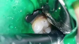 Dr Mahmoud Nasani A large carious lesion managment on tooth 47 [upl. by Sices434]