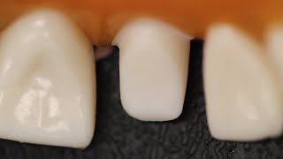 All Ceramic Crown Anterior Tooth Preparation [upl. by Mimajneb912]