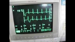 the valsalva maneuver and sinustachycardia  cardiac arrhythmia [upl. by Ias600]