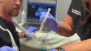 Ultrasound Guided SI Joint Injections R3 Stem Cell 844 GETSTEM [upl. by Waylin]