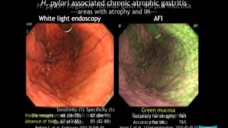 Advanced Imaging in the Diagnosis of Gastric Intestinal Metaplasia The Experts Approach [upl. by Nij207]