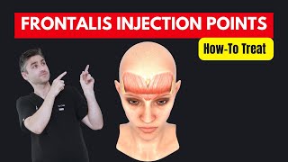 HowTo Treat The Frontalis With Botox  Dr Chris Hutton Aesthetics Training [upl. by Tyra]