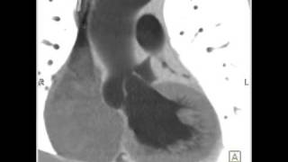 Cardiac Dilated aortic root and sinuses of Valsalva 6 of 10 [upl. by Akehsay]