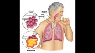 Probiotics Bifidobacterium Breve amp Lactobacillus Rhamnosus Helps Asthma  Inflammation T cell [upl. by Ecirtael]