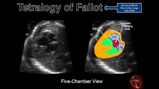 Fetal Echocardiography Tetralogy of Fallot [upl. by Levram36]