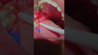 Infected Wisdom Tooth Extraction  Check out the full video out now dentist satisfying [upl. by Lerej162]