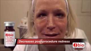 CO2 Laser Skin Tightening PostProcedure Treatment [upl. by Feodor]