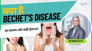 क्या है BECHETS DISEASE का कारण और सही ईलाज  What is Bechets Disease  Dr Gaurav Seth [upl. by Yrbua36]