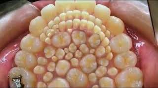 232 teeth in mouth Dental amaze HyperdontiaRemoved by Indian doctor [upl. by Finella140]