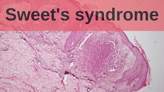 Sweets Syndrome  Pathology mini tutorial [upl. by Schaaff]