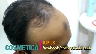 Hair Replacement fitting video Bangladesh  Hair system baldness Hair Pieces [upl. by Annekim538]