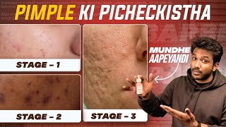 Pimples ki Pichekistha  Acne causes prevention and products  Nalla machalu bye bye [upl. by Elrem]