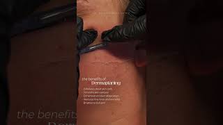 Our most popular facial service Dermaplaning  this treatment exfoliates your skin for a major glow [upl. by Timmi]