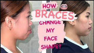 BRACES JOURNEY  HOW MY BRACES CHANGE MY FACE SHAPE  WITH ENGLISH SUBTITLE  ABUDHABI [upl. by Nodnyl]