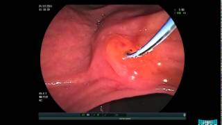 Choledocholithiasis  Sphincterotomy and Stone Extraction with a Basket [upl. by Ponton]