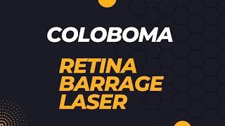 COLOBOMA  BARRAGE LASER retina [upl. by Zsolway102]