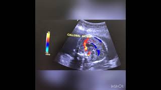 Early uteroplacental insufficiency at 22 weeks [upl. by Uah]